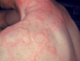 Аллергия на тепло