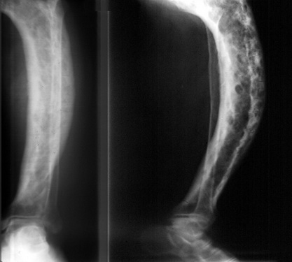 Костная болезнь Педжета, часть II: Рентгенологическая диагностика, исцеление