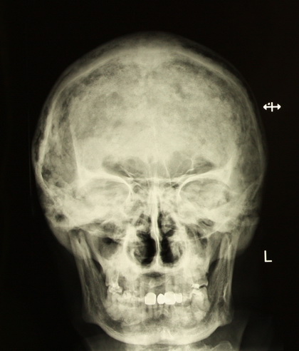 Костная болезнь Педжета, часть II: Рентгенологическая диагностика, исцеление