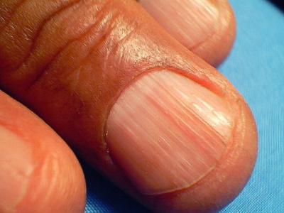 Ногти, часть II: Дистрофические конфигурации