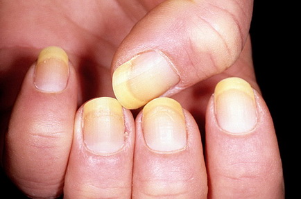 Ногти, часть III: белоснежные, желтоватые, темные ногти