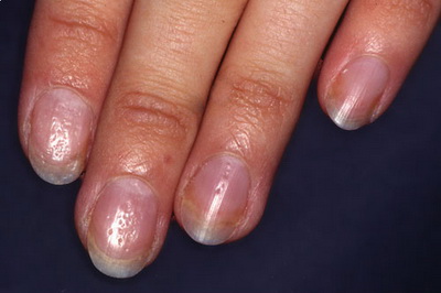 Ногти, часть III: белоснежные, желтоватые, темные ногти