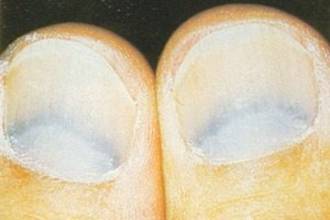 Ногти, часть IV: Голубые, красноватые, карие ногти