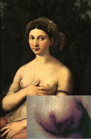 Рак груди в живописи и скульптуре, часть III