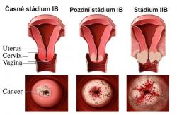 Рак шеи матки - преждевременное обнаружение и предупреждение